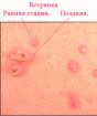 Cosa dice il dottor Komarovsky sulla varicella nei bambini?