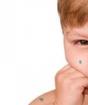 Piano di trattamento per un bambino con la varicella