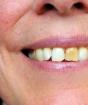 הלבנת השיניים הטובה ביותר: כאשר יש יותר יתרונות מחסרונות