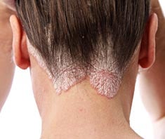 Eucerin®: A bőrről | Psoriasis - tünetek, okok és megoldások